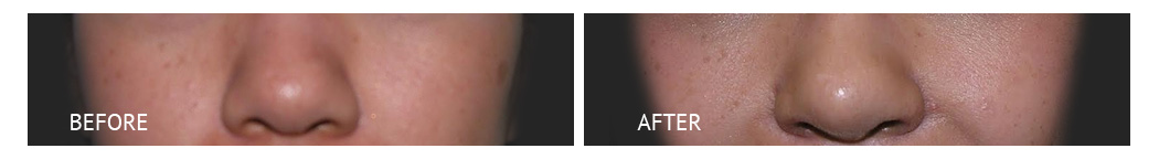 best cost nose job philippines before and after
