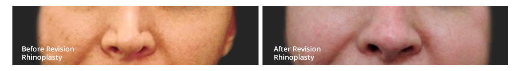 rhinoplasty with goretex implants before and after