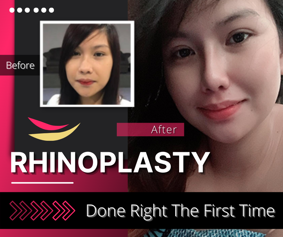 Best Rhinoplasty Philippines